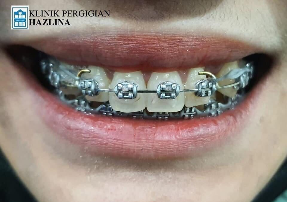 BAGAIMANA UNTUK TAHU BRACES ITU ORIGINAL?