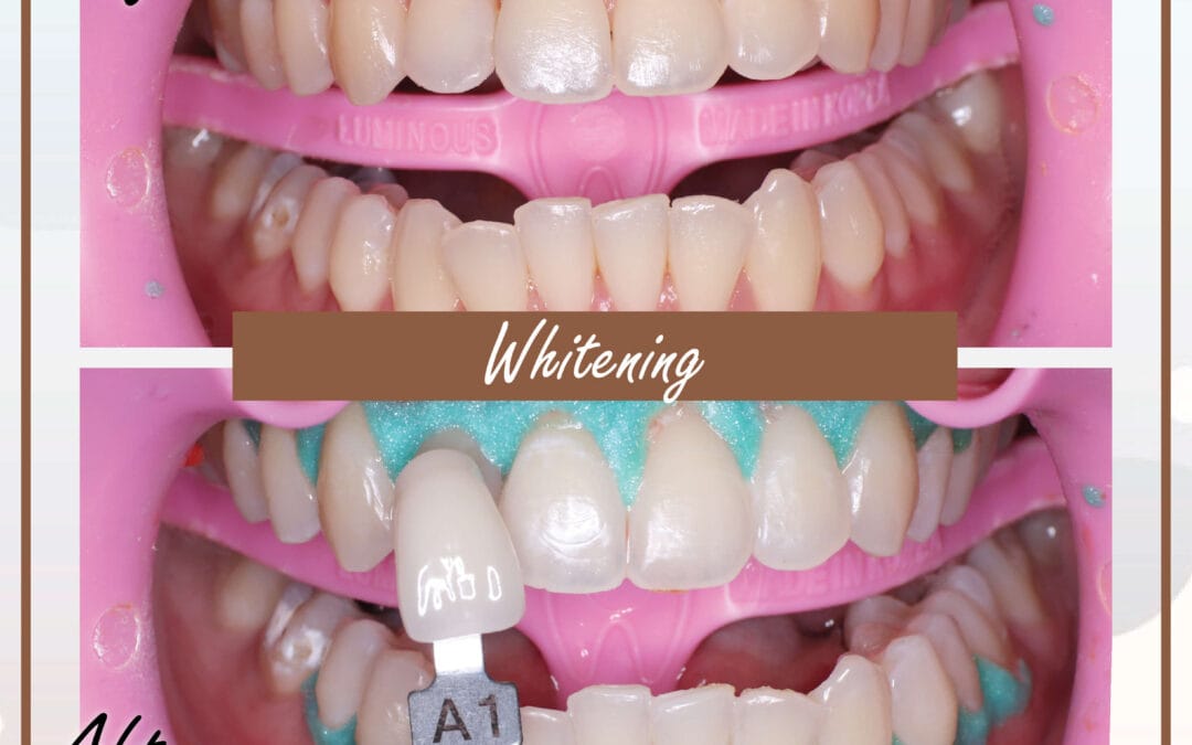 Dental Whitening