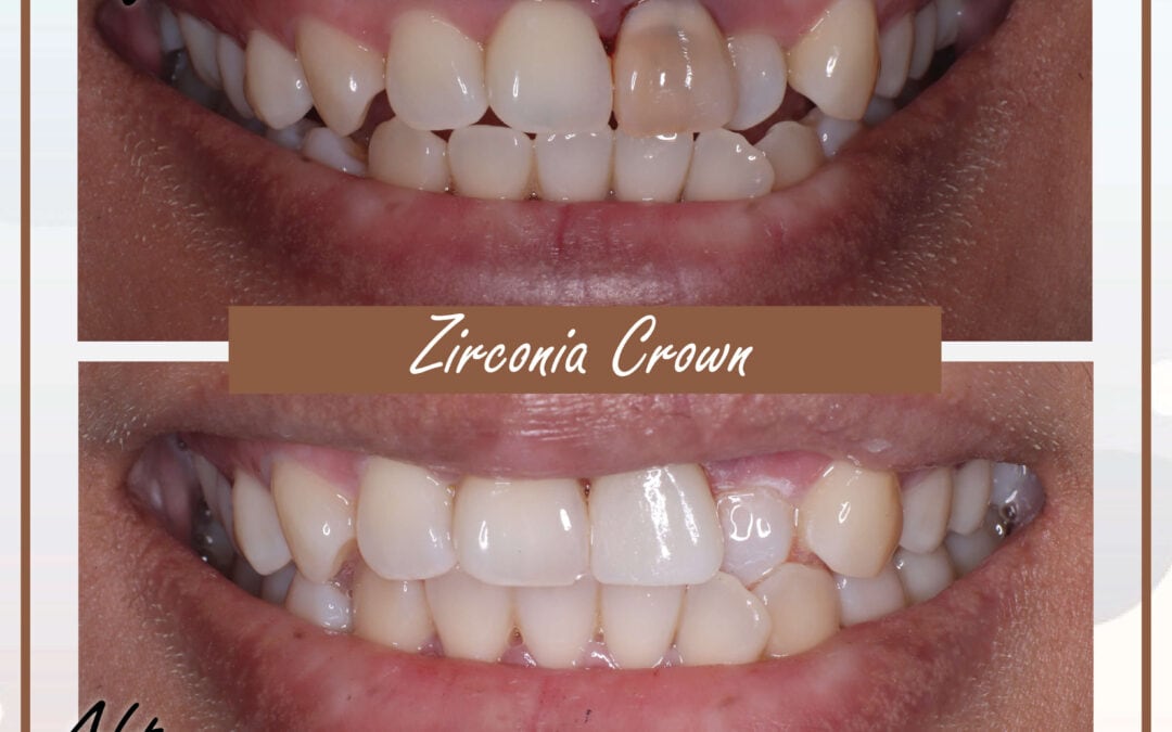 Dental Crown