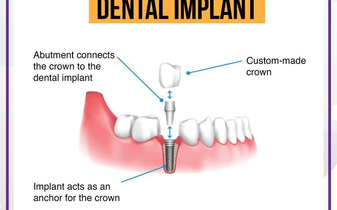Dental Implant