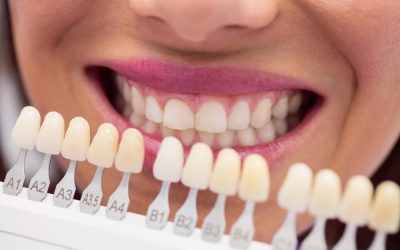 Understanding Dental Crowns: Purpose, Procedure, and Aftercare
